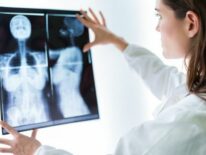Descubren factor que explica la metástasis de huesos en el cáncer de mama