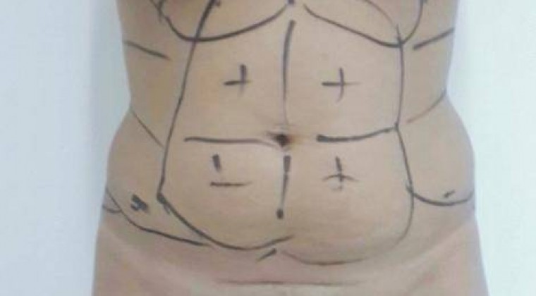 Sorteo de cirugías: médico hace uso de derecho a réplica