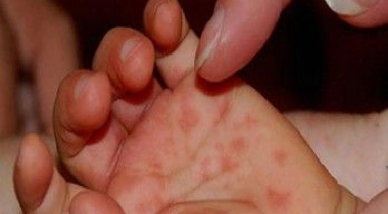 Reportan virus que ataca manos y pies de niños