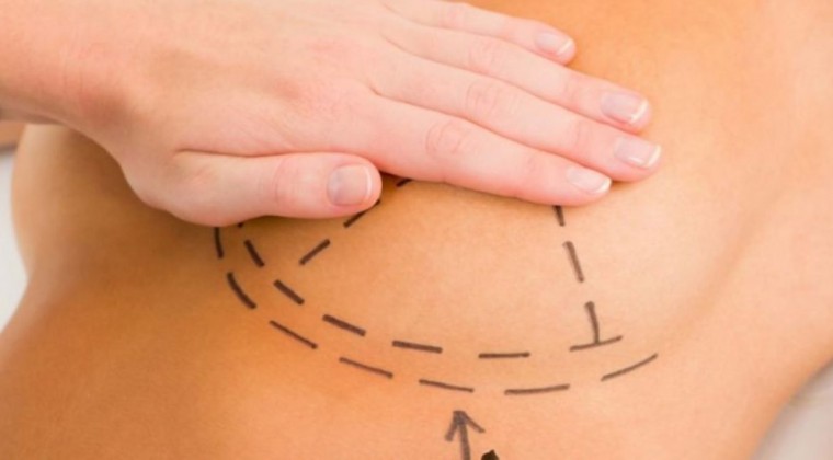 Cáncer de mama: La reconstrucción no es solo estética sino devolverles la salud, asegura cirujano