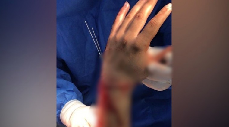 Sufrió accidente laboral y perdió la mano, en IPS se la implantaron con cirugía reconstructiva