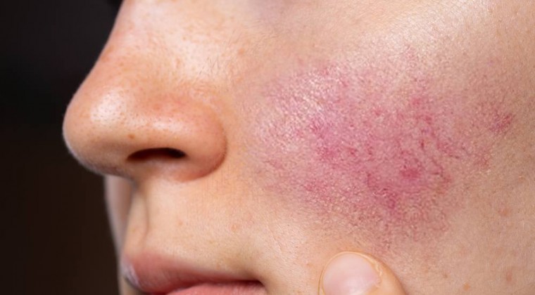 Rosácea: afección crónica de origen desconocido y de tratamiento prolongado