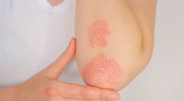 La Psoriasis: especialistas buscan visibilizar esta enfermedad que afecta piel, uñas y articulaciones