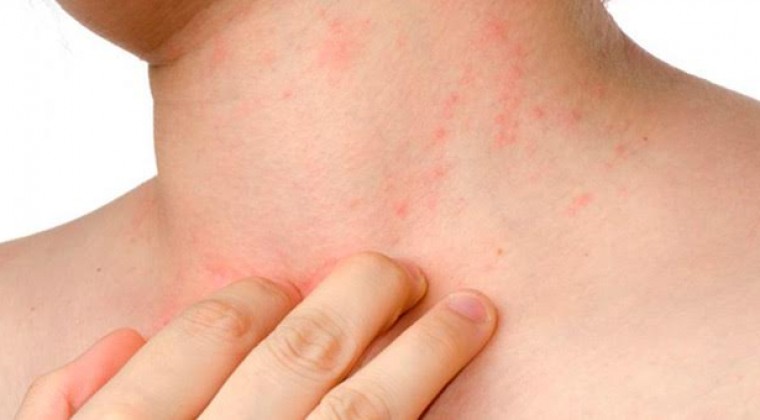 ¿Qué sabemos de la Dermatitis Atópica?