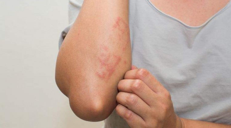 Psoriasis puede controlarse siguiendo el tratamiento correcto