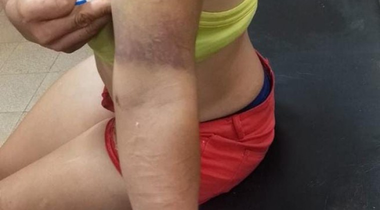 Derramó aceite caliente a su pareja tras una discusión
