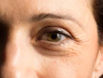 Arrugas a los 30: cómo combatir los signos de la edad y no arrepentirte a los 40