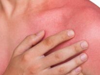 Cómo actuar cuando se sufre una quemadura