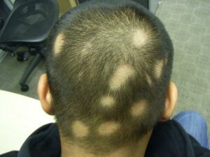 EEUU aprueba primera píldora para el tratamiento de la alopecia