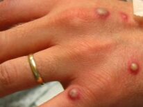 Detectan en EE.UU. dos cepas distintas de viruela del mono